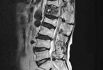 요추압박골절 MRI